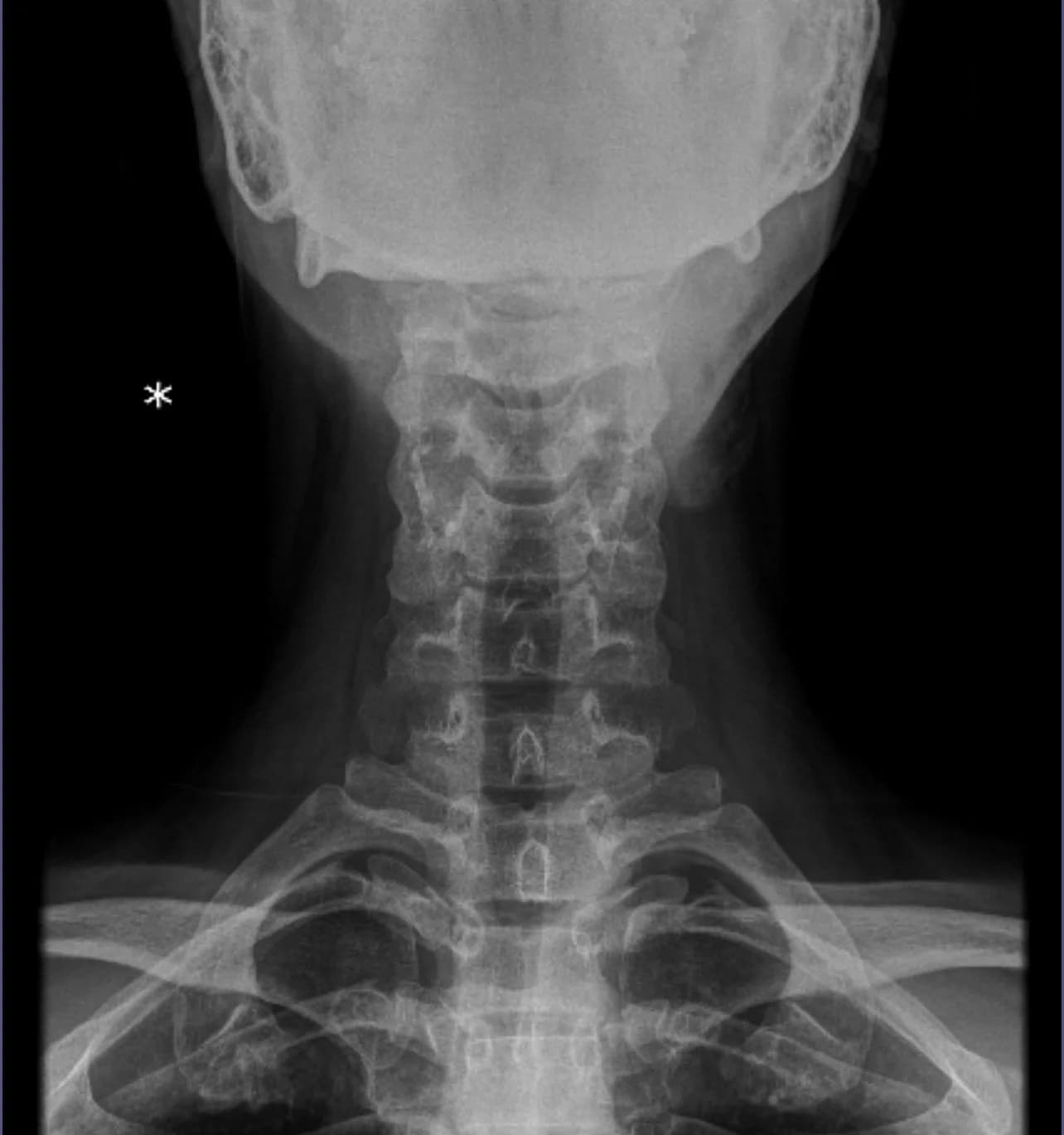 Columna Cervical